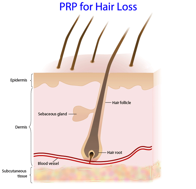PRP for Hair Loss