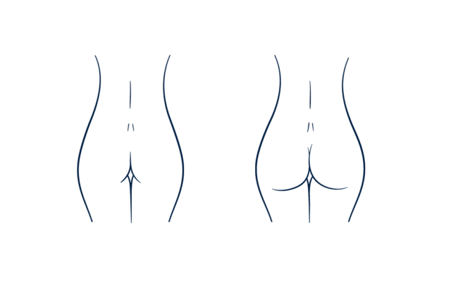 Butt implants before and after