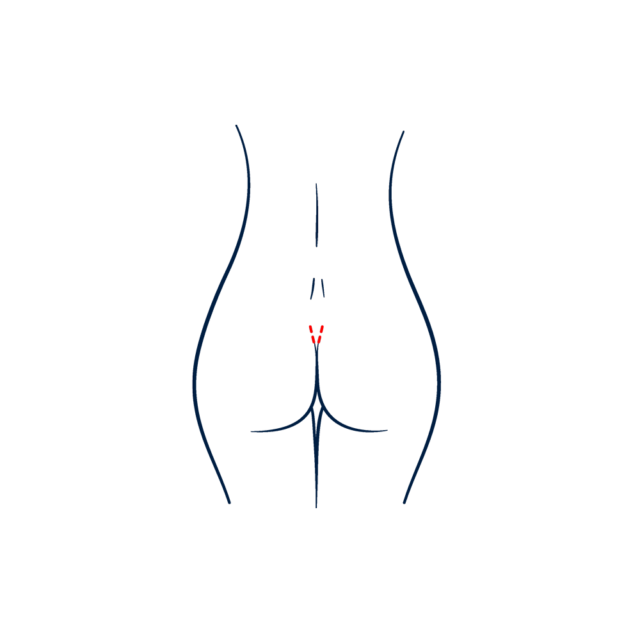 Butt implant incisions