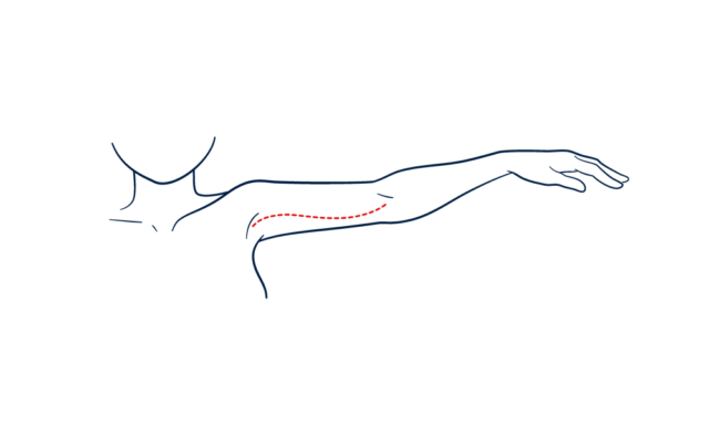 Arm Lift incision